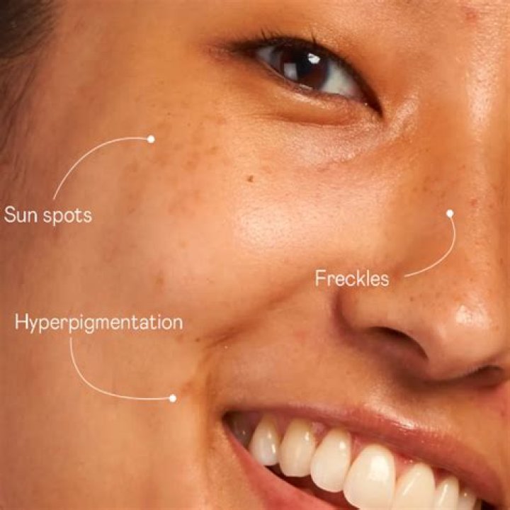 Are all freckles sun damage?