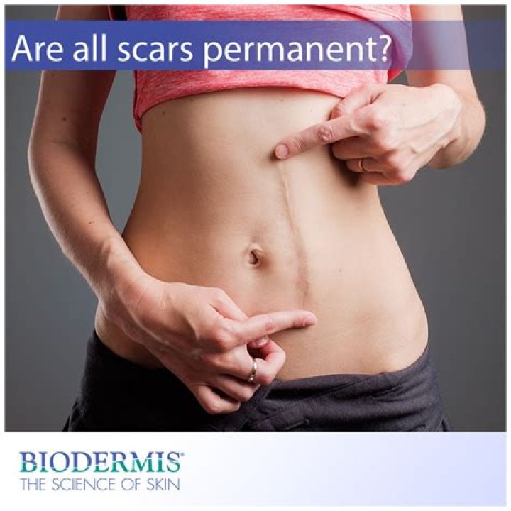 Are all scars permanent?