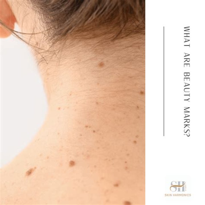 Are beauty marks genetic?