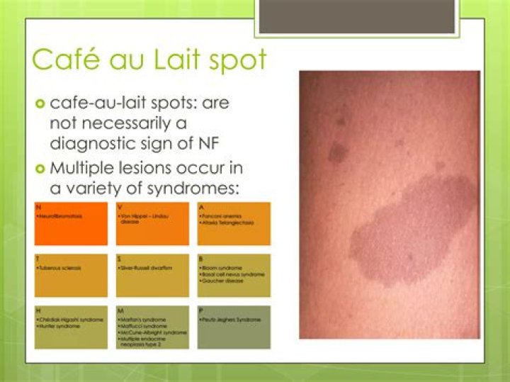 Are cafe au lait spots normal?
