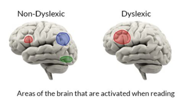 Are dyslexics more intelligent?