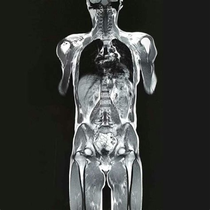 Are full body MRI scans worth it?