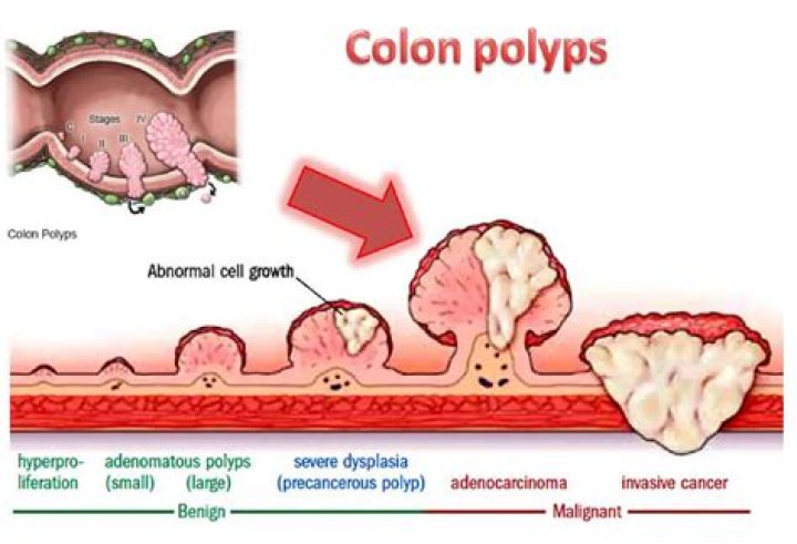 Are granulomas the same as polyps?