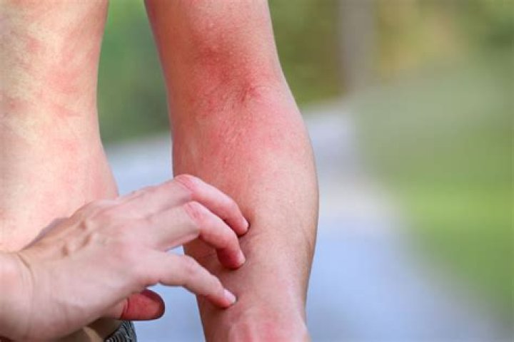 Are heat rashes harmful?