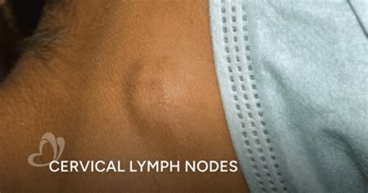 Are lymphoma nodes movable?