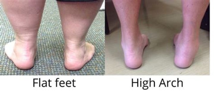 Are most athletes flat-footed?