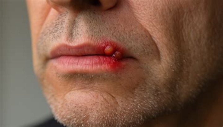 Are mouth sores contagious?