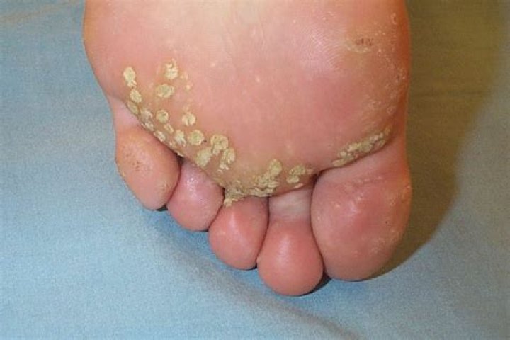 Are plantar warts cancerous?