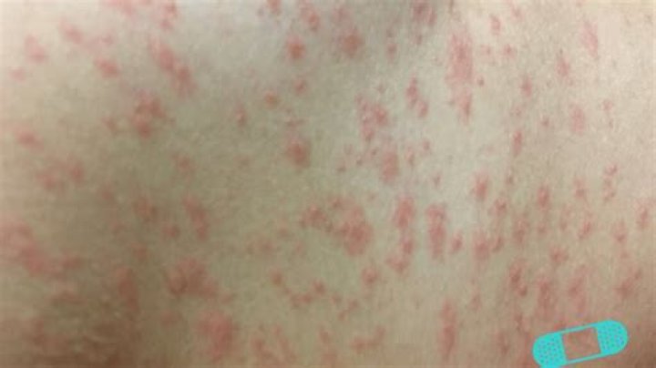 Are rashes contagious?