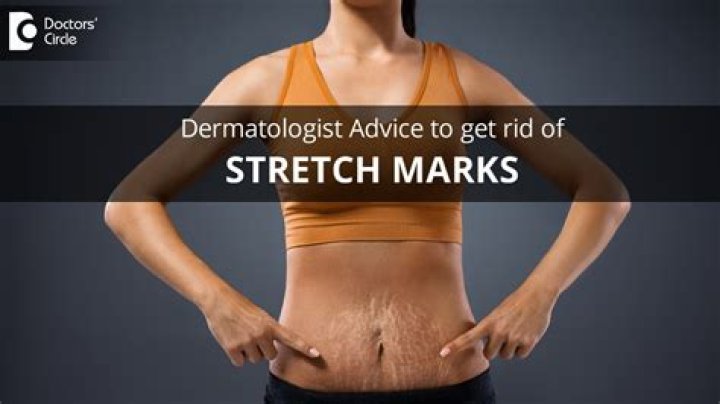 Are stretch marks forever?
