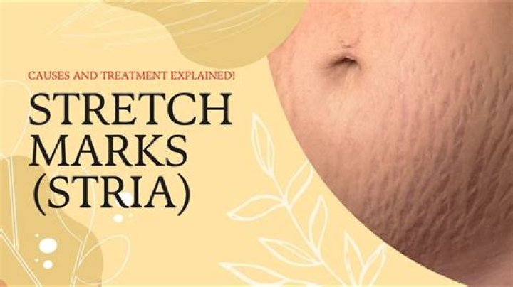 Are stretch marks normal for a 16 year old?