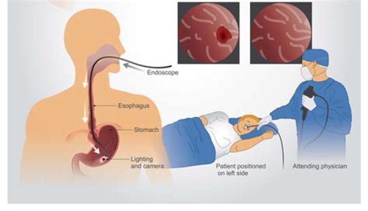 Are you awake for an upper endoscopy?