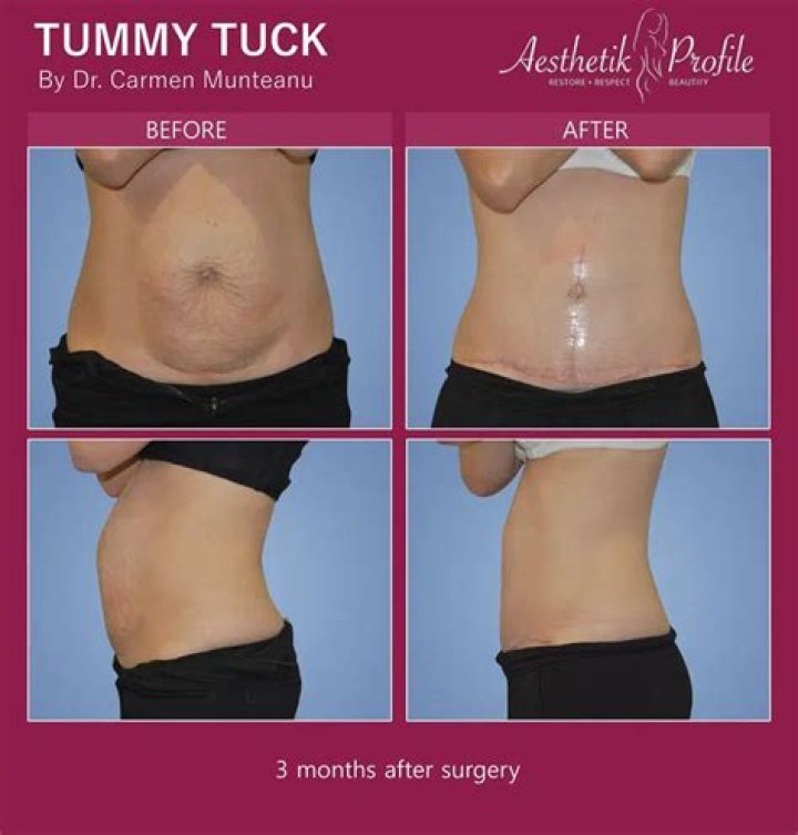 Are you put under for a tummy tuck?