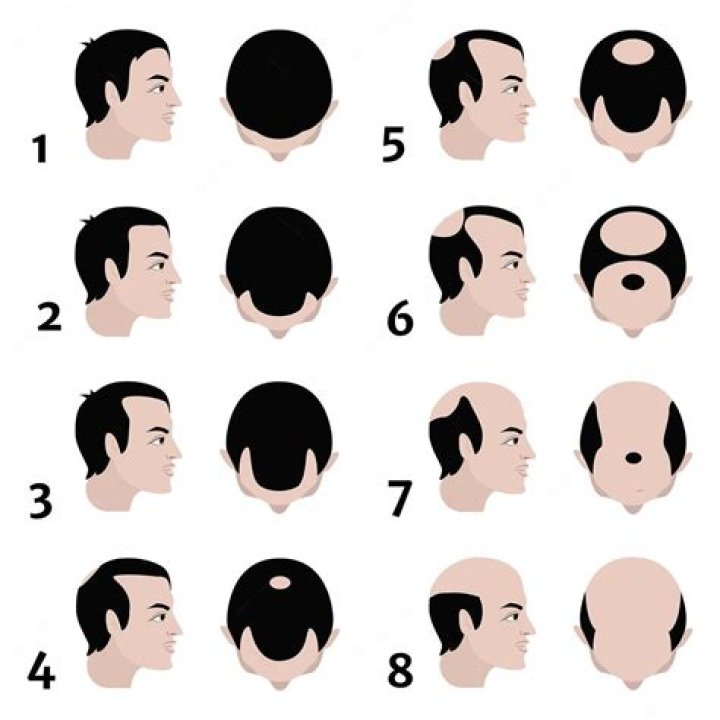 At what age do guys start balding?