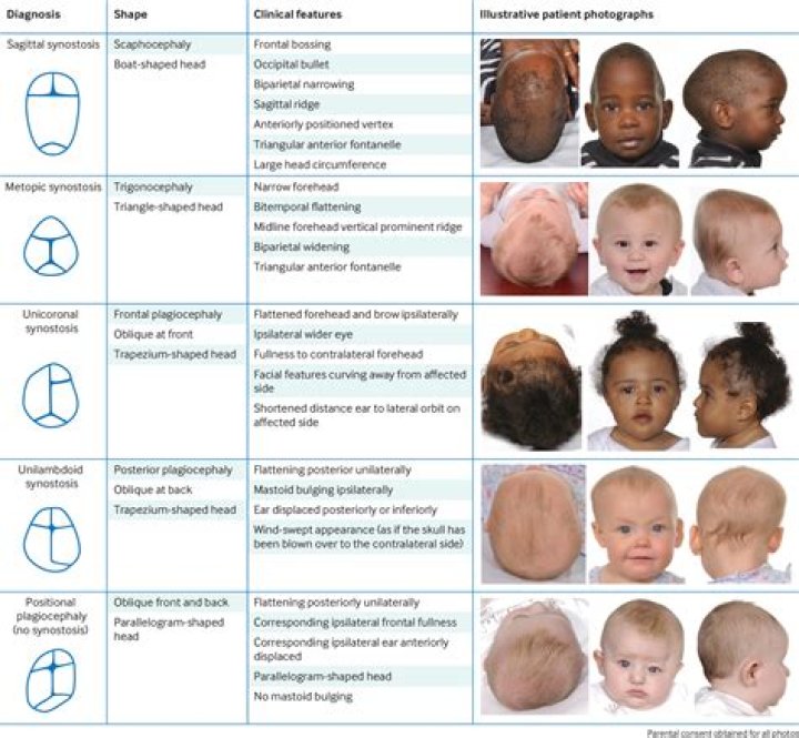 At what age is craniosynostosis diagnosed?