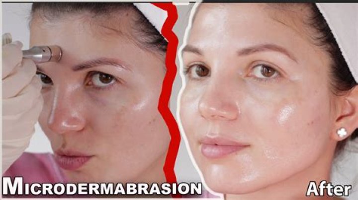 At what age should you get microdermabrasion?