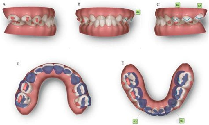 Can a 8 year old wear Invisalign?