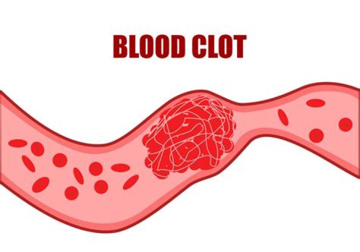 Can a blood clot come out of a boil?