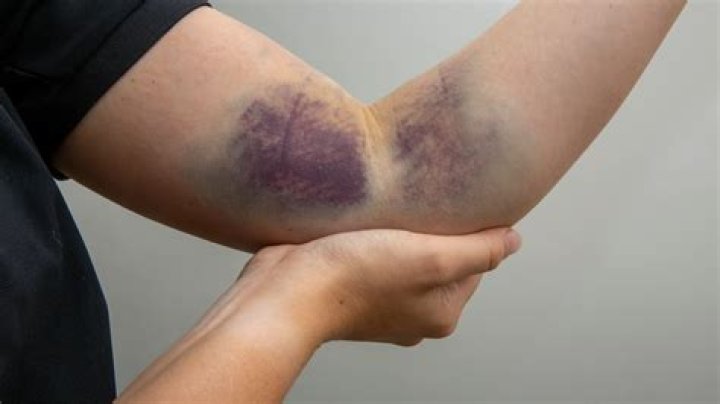 Can a bruise show up a week after injury?