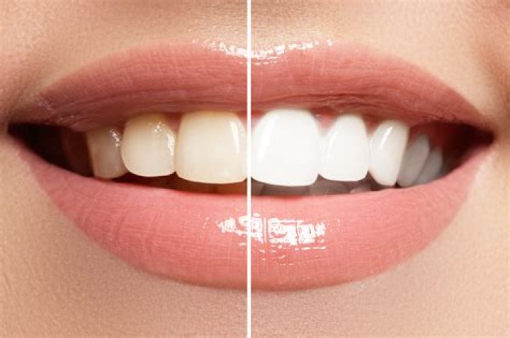 Can a discolored tooth be whitened?