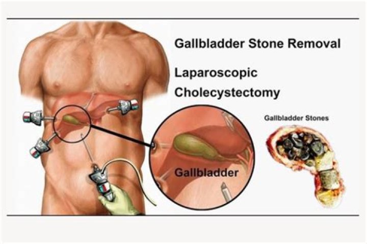 Can a gallbladder disappear?