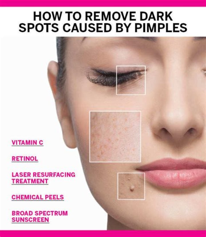 Can a laser remove dark spots?