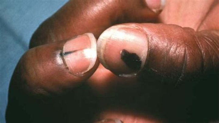 Can a melanoma disappear?