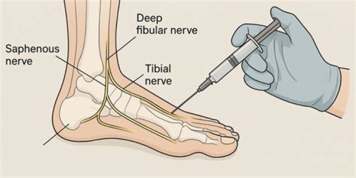 Can a nerve block help neuropathy?