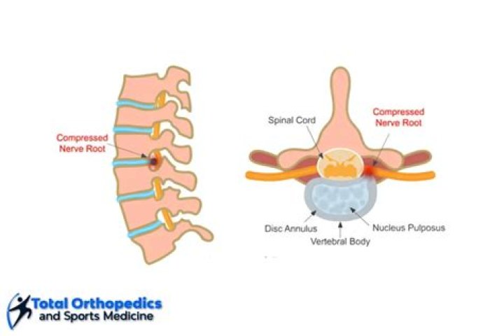 Can a pinched nerve cause dizziness?