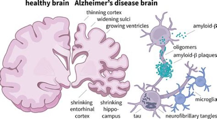 Can ADHD turn into Alzheimer's?
