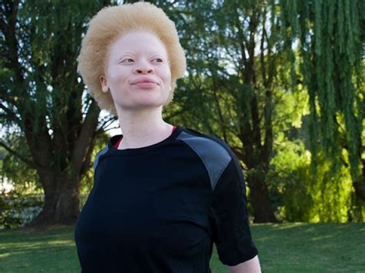 Can albinos have black hair?