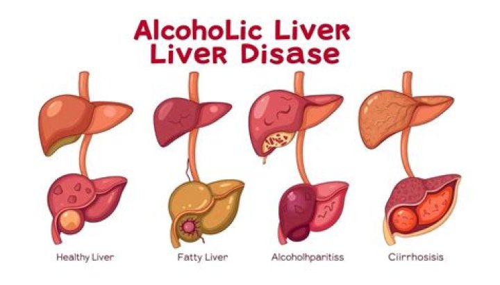 Can alcoholic liver disease be reversed?
