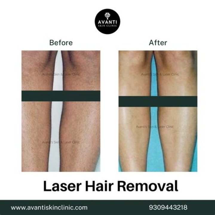 Can an 11 year old get laser hair removal?