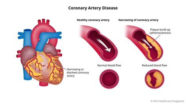 Can blood pressure indicate blocked arteries?