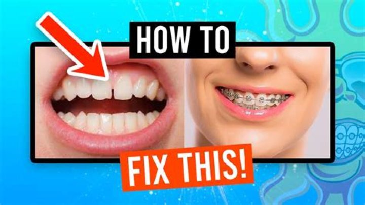 Can braces fix double teeth?