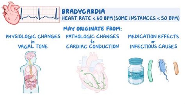 Can bradycardia cause stroke?