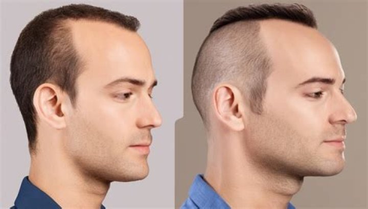 Can castor oil grow hairline?