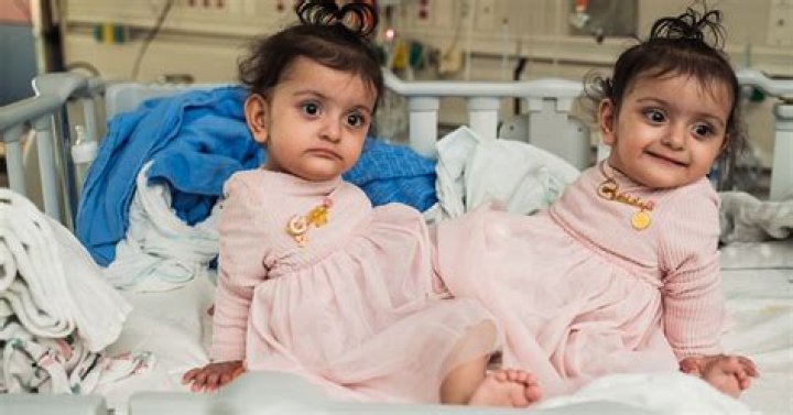 Can conjoined twins be separated after one dies?