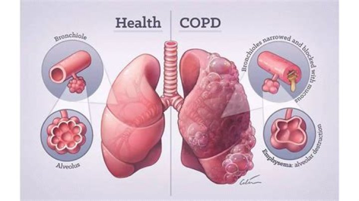 Can COPD affect your bowels?