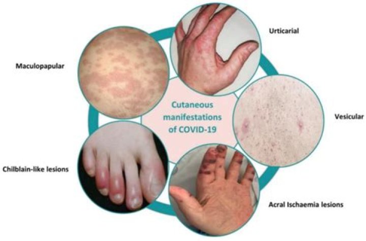 Can Covid cause extreme joint pain?