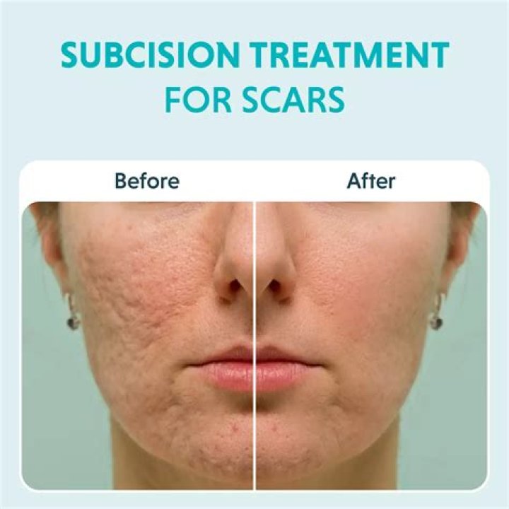 Can dermabrasion remove old scars?