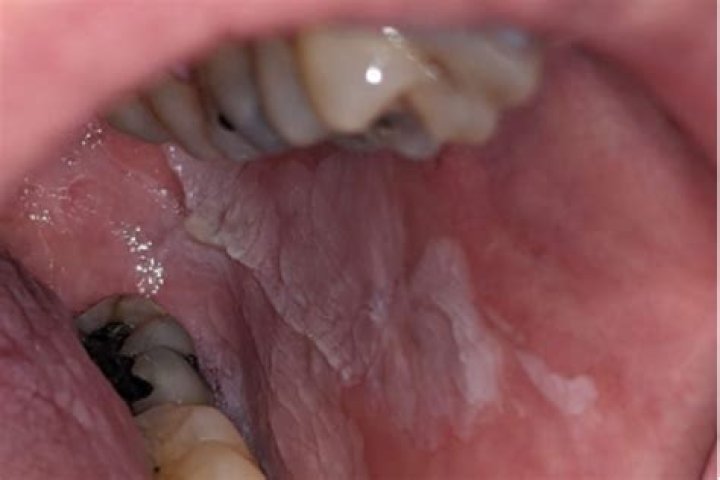 Can diabetes cause oral hairy leukoplakia?