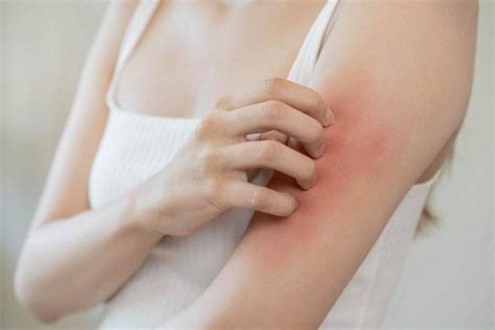 Can eczema go away on its own?
