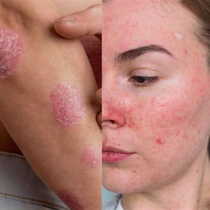 Can eczema heal itself?