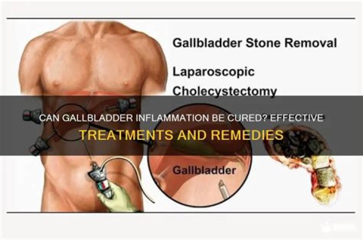 Can gallbladder inflammation be cured?