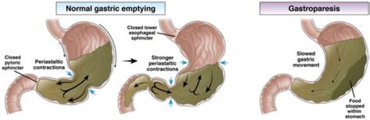 Can gastroparesis be seen on CT scan?