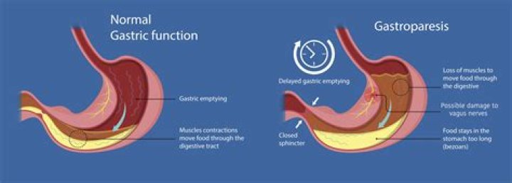 Can gastroparesis cause burping?