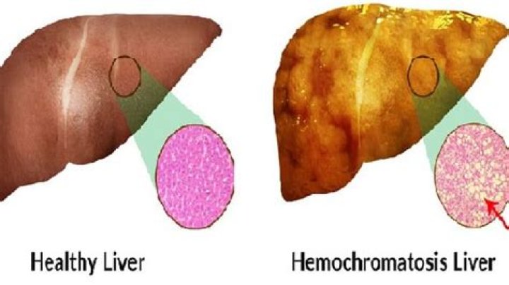 Can hemochromatosis cause skin problems?