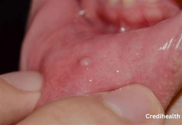 Can I pop a mucous cyst?