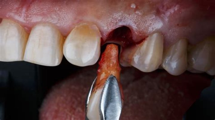 Can I shower after tooth extraction?